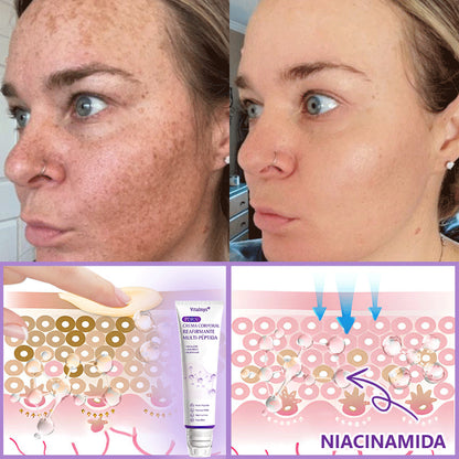 30% de descuento exclusivo: Vitalisys® 💎💎 Crema Corporal con Rodillo PDRN y Multi-Péptidos: Antiedad, Hidratación, Reafirmación, Reparación de la Piel, Tono Uniforme, Tratamiento de Manchas y Acné, Reducción de Verrugas y Lunares.
