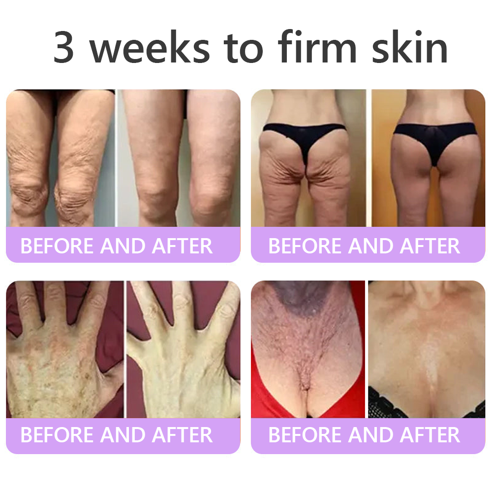 Vitalisys® 🍅 Crema Corporal con Rodillo de PDRN y Multi-Péptidos: Antiedad, Hidratación, Reafirmación, Reparación de la Piel, Tono Uniforme, Tratamiento de Acné y Manchas, Reducción de Verrugas y Lunares, y Alivio de la Psoriasis.