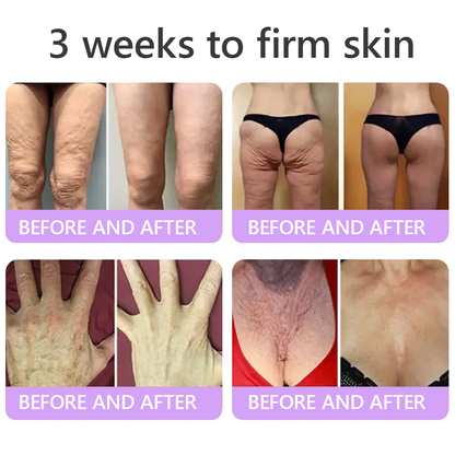 Vitalisys® 🍅 Crema Corporal con Rodillo de PDRN y Multi-Péptidos: Antiedad, Hidratación, Reafirmación, Reparación de la Piel, Tono Uniforme, Tratamiento de Acné y Manchas, Reducción de Verrugas y Lunares, y Alivio de la Psoriasis.