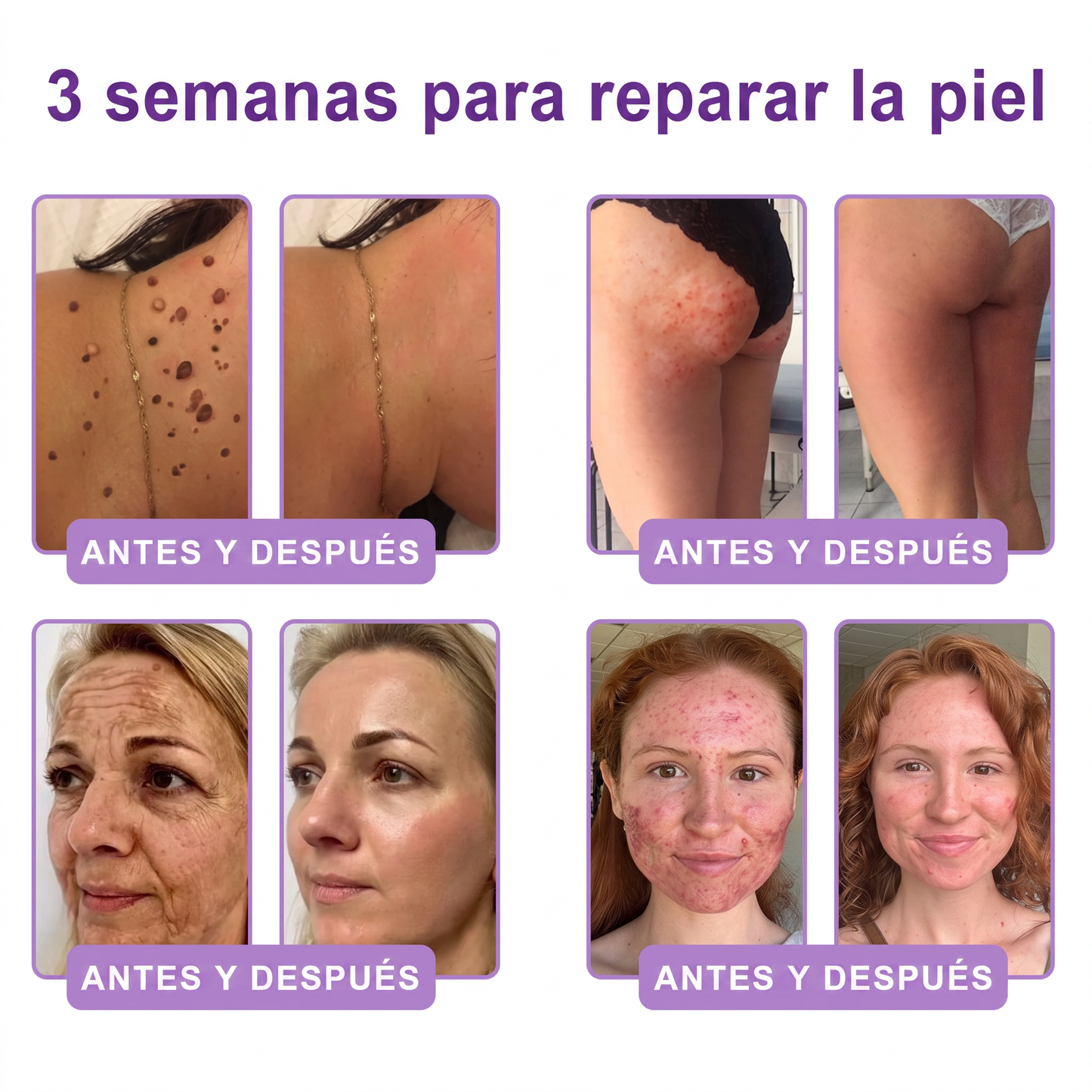 30% de descuento exclusivo: Vitalisys® 💎💎 Crema Corporal con Rodillo PDRN y Multi-Péptidos: Antiedad, Hidratación, Reafirmación, Reparación de la Piel, Tono Uniforme, Tratamiento de Manchas y Acné, Reducción de Verrugas y Lunares.