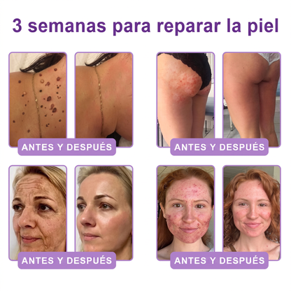 30% de descuento exclusivo: Vitalisys® 💎💎 Crema Corporal con Rodillo PDRN y Multi-Péptidos: Antiedad, Hidratación, Reafirmación, Reparación de la Piel, Tono Uniforme, Tratamiento de Manchas y Acné, Reducción de Verrugas y Lunares.
