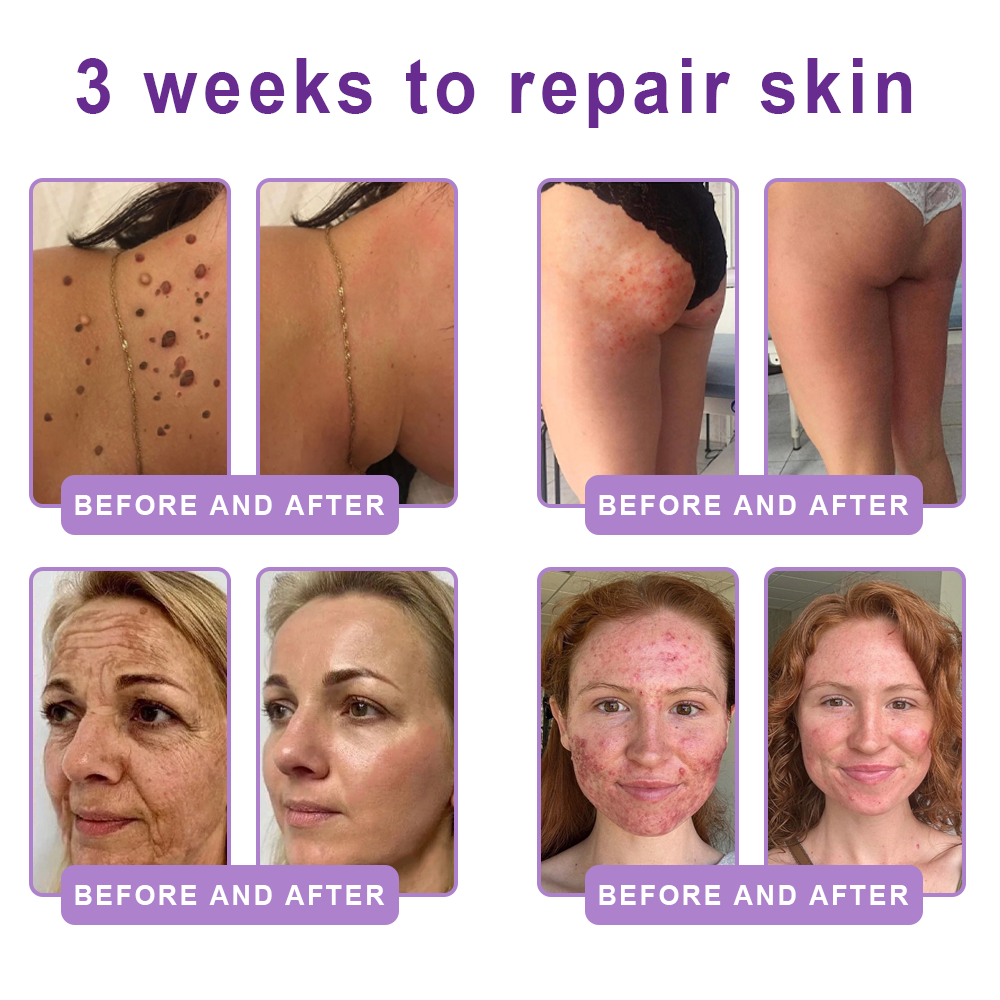 Vitalisys® 🍅 Crema Corporal con Rodillo de PDRN y Multi-Péptidos: Antiedad, Hidratación, Reafirmación, Reparación de la Piel, Tono Uniforme, Tratamiento de Acné y Manchas, Reducción de Verrugas y Lunares, y Alivio de la Psoriasis.