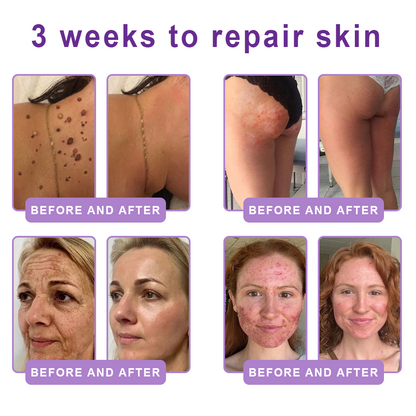 Vitalisys® 🍅 Crema Corporal con Rodillo de PDRN y Multi-Péptidos: Antiedad, Hidratación, Reafirmación, Reparación de la Piel, Tono Uniforme, Tratamiento de Acné y Manchas, Reducción de Verrugas y Lunares, y Alivio de la Psoriasis.