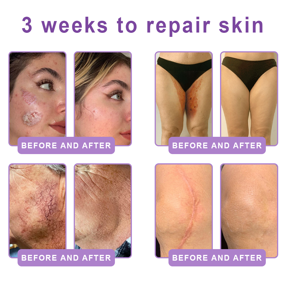 Vitalisys® 🍅 Crema Corporal con Rodillo de PDRN y Multi-Péptidos: Antiedad, Hidratación, Reafirmación, Reparación de la Piel, Tono Uniforme, Tratamiento de Acné y Manchas, Reducción de Verrugas y Lunares, y Alivio de la Psoriasis.