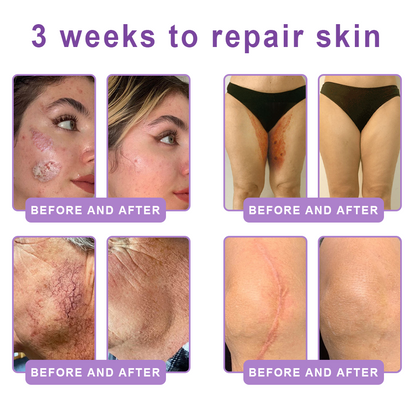 Vitalisys® 🍅 Crema Corporal con Rodillo de PDRN y Multi-Péptidos: Antiedad, Hidratación, Reafirmación, Reparación de la Piel, Tono Uniforme, Tratamiento de Acné y Manchas, Reducción de Verrugas y Lunares, y Alivio de la Psoriasis.