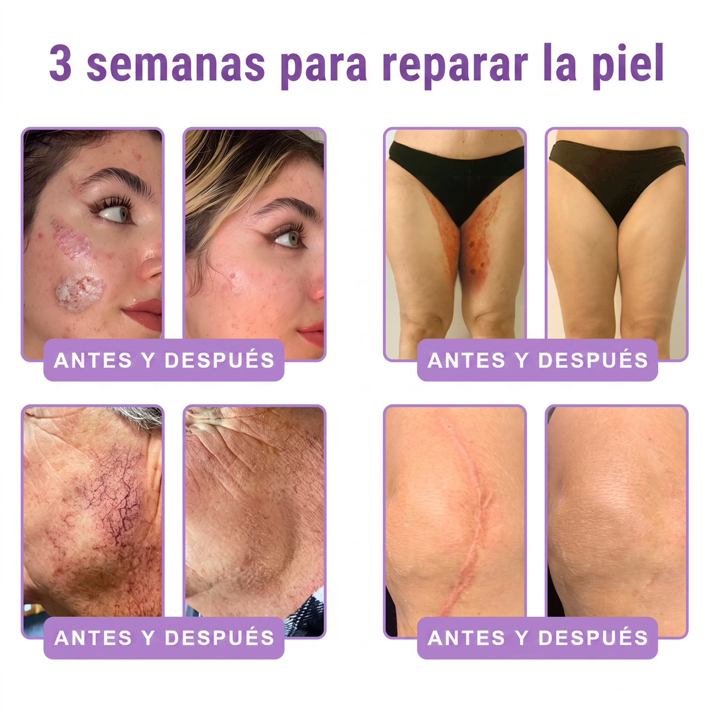 30% de descuento exclusivo: Vitalisys® 💎💎 Crema Corporal con Rodillo PDRN y Multi-Péptidos: Antiedad, Hidratación, Reafirmación, Reparación de la Piel, Tono Uniforme, Tratamiento de Manchas y Acné, Reducción de Verrugas y Lunares.