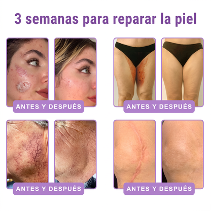 30% de descuento exclusivo: Vitalisys® 💎💎 Crema Corporal con Rodillo PDRN y Multi-Péptidos: Antiedad, Hidratación, Reafirmación, Reparación de la Piel, Tono Uniforme, Tratamiento de Manchas y Acné, Reducción de Verrugas y Lunares.