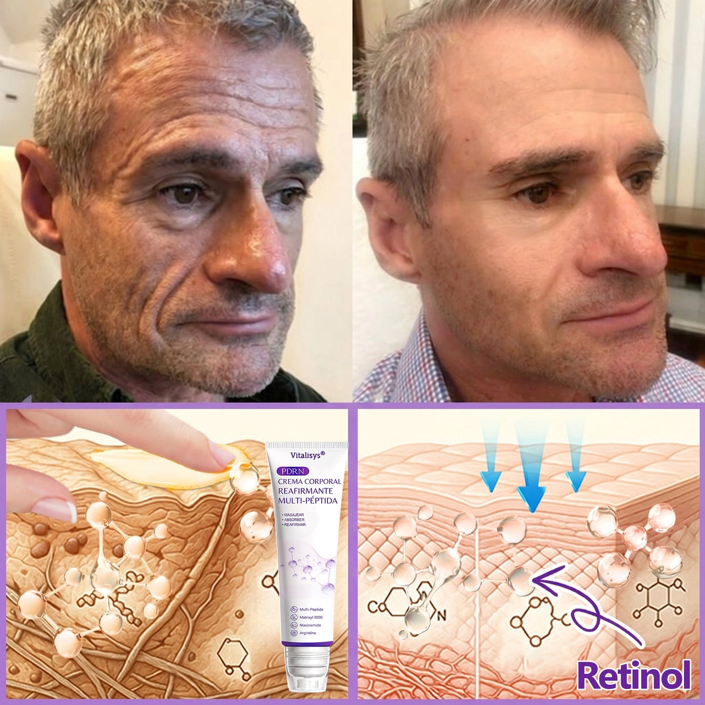 30% de descuento exclusivo: Vitalisys® 💎💎 Crema Corporal con Rodillo PDRN y Multi-Péptidos: Antiedad, Hidratación, Reafirmación, Reparación de la Piel, Tono Uniforme, Tratamiento de Manchas y Acné, Reducción de Verrugas y Lunares.